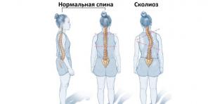 Was ist Skoliose und wie man es beheben